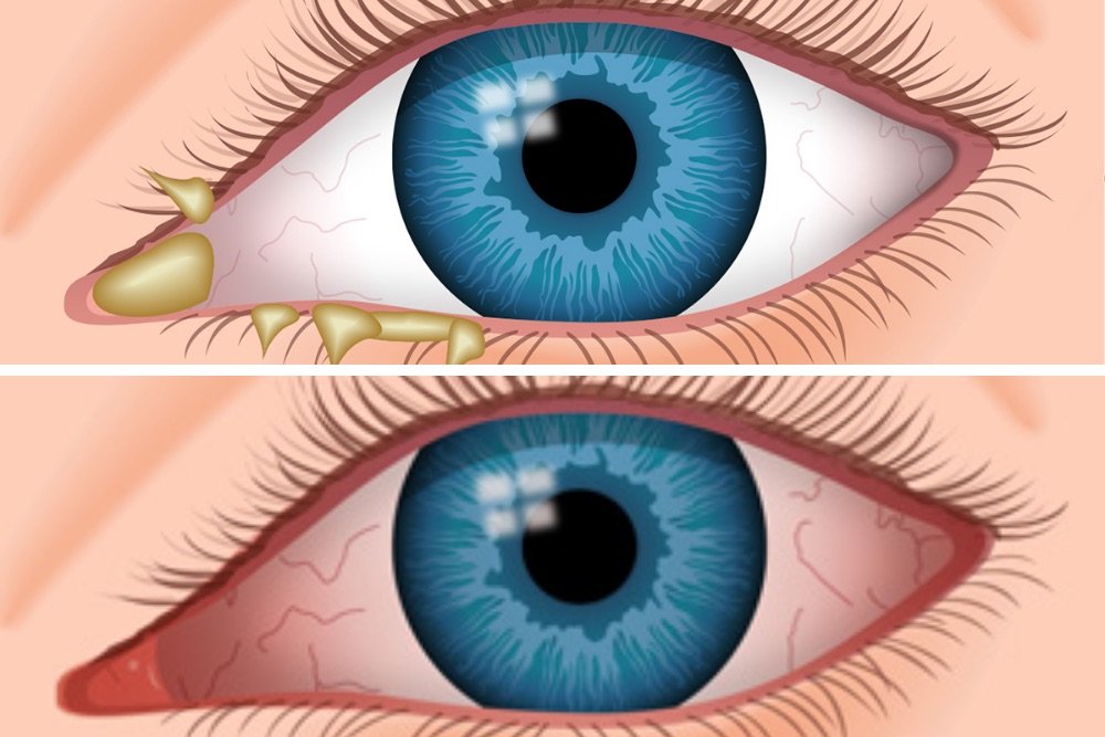 difference-between-allergies-and-pink-eye-the-eye-news