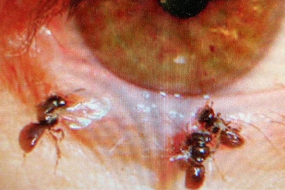 Eye Doctor Finds Four Sweat Bees Feeding Inside a Woman's Eye_1