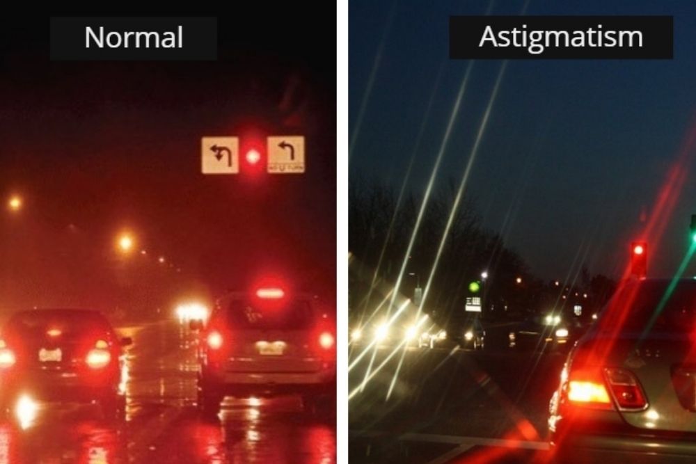 astigmatism