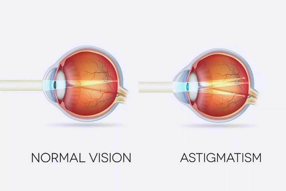 What Is Astigmatism In Both Eyes