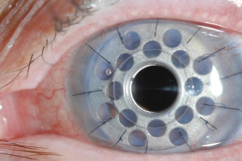 Is Transplant of the Whole Human Eye Possible? - The Eye News