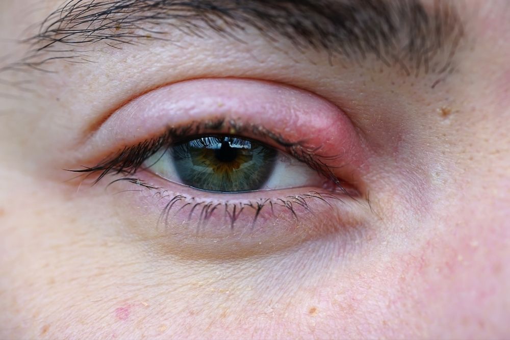 eyeball hurts to touch and blink