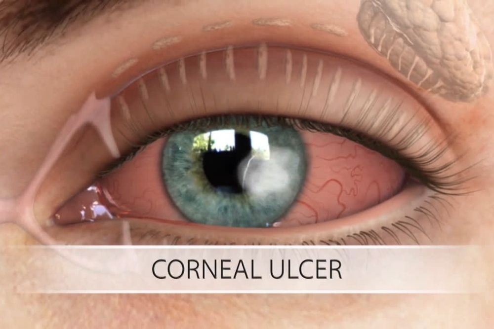 corneal-ulcer-keratitis-causes-and-treatment-the-eye-news