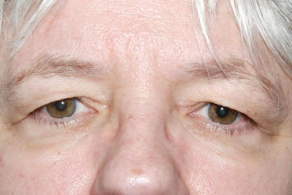 sagging-eyelid-or-droopy-eyelid-ptosis-causes-treatment-health-kura