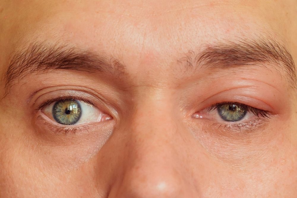 top-causes-of-swollen-eyelids