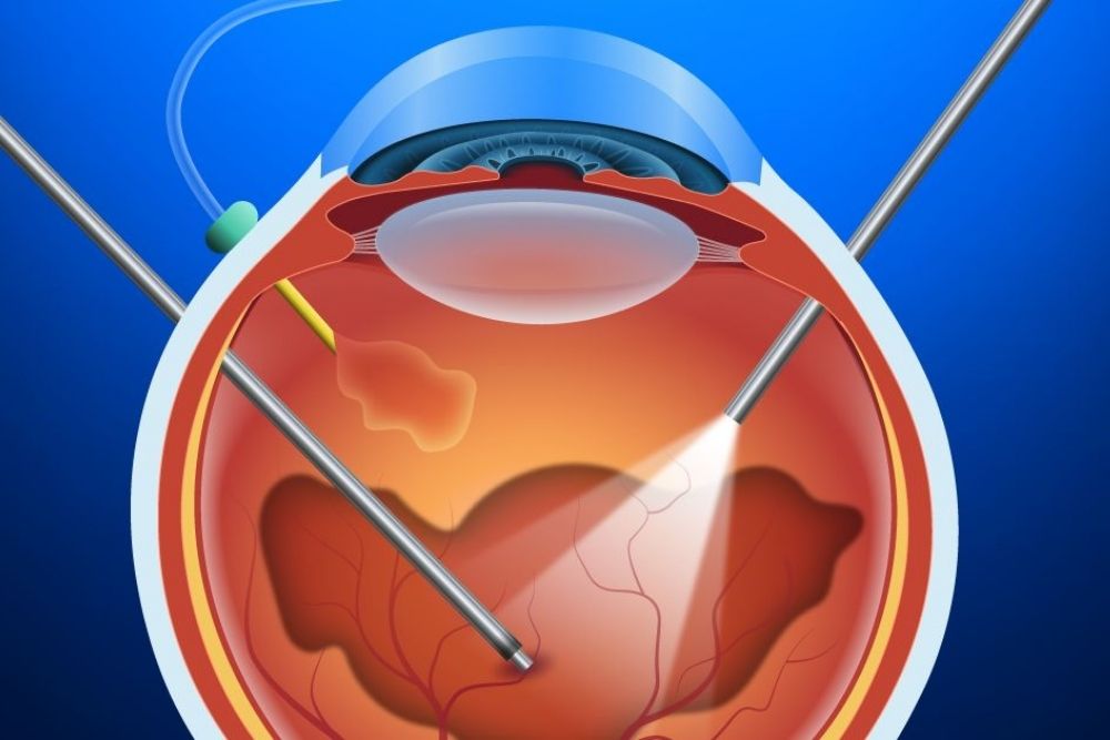 causes of detached retina