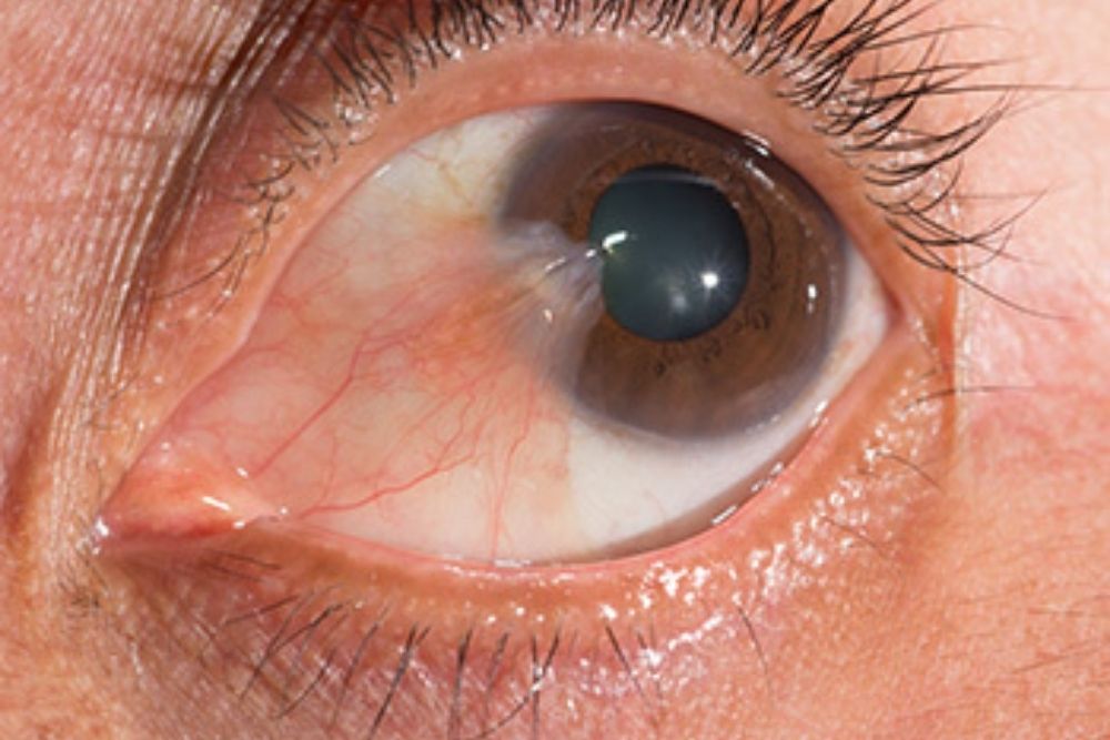 brown-spot-on-your-eye-what-it-means-and-how-to-treat-it