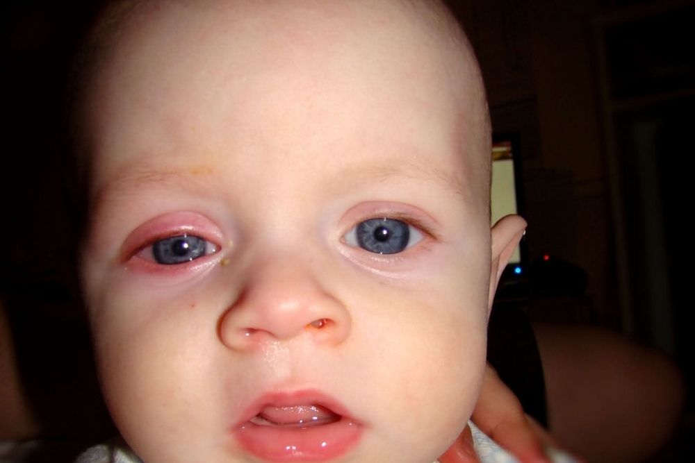 Identification and Treatment of Pink Eye in Babies