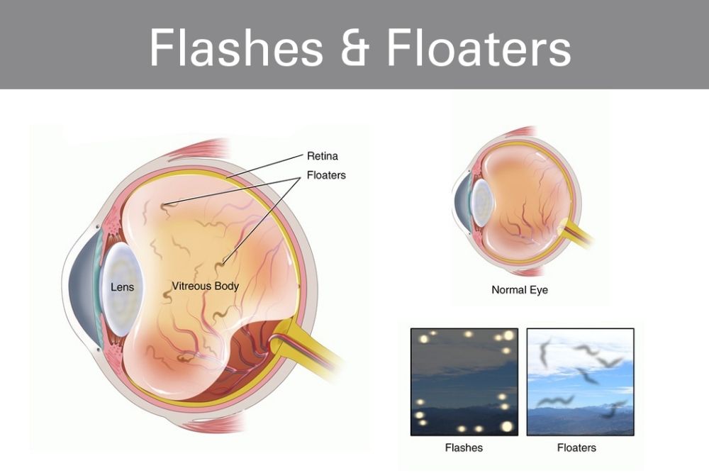 comparison between eye floaters and flashes