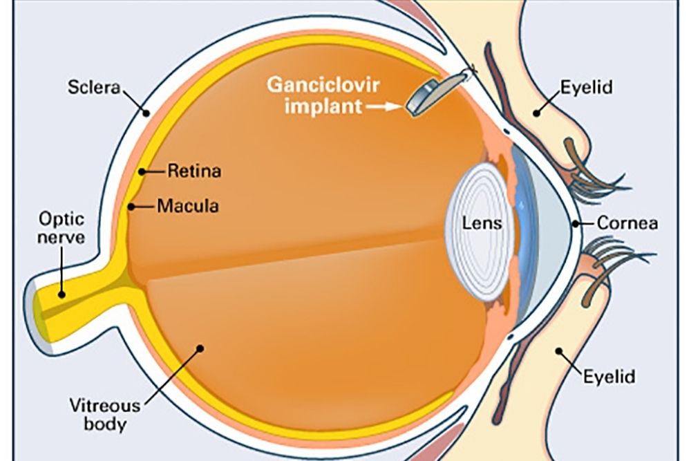 cytomegalovirus retinitis at mga sintomas