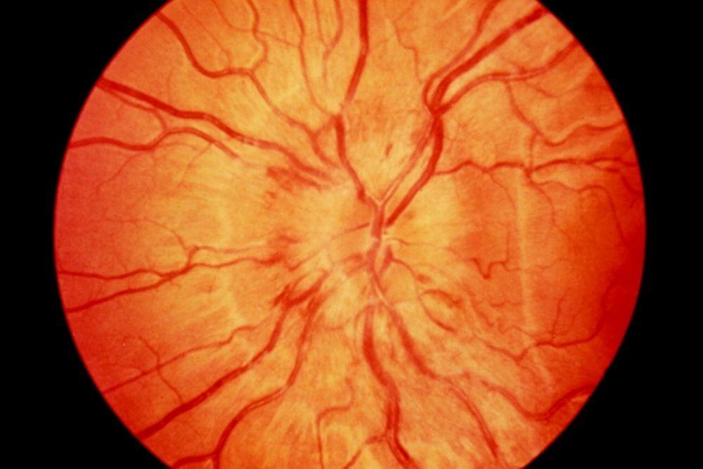 Optic Nerve Issues Symptoms