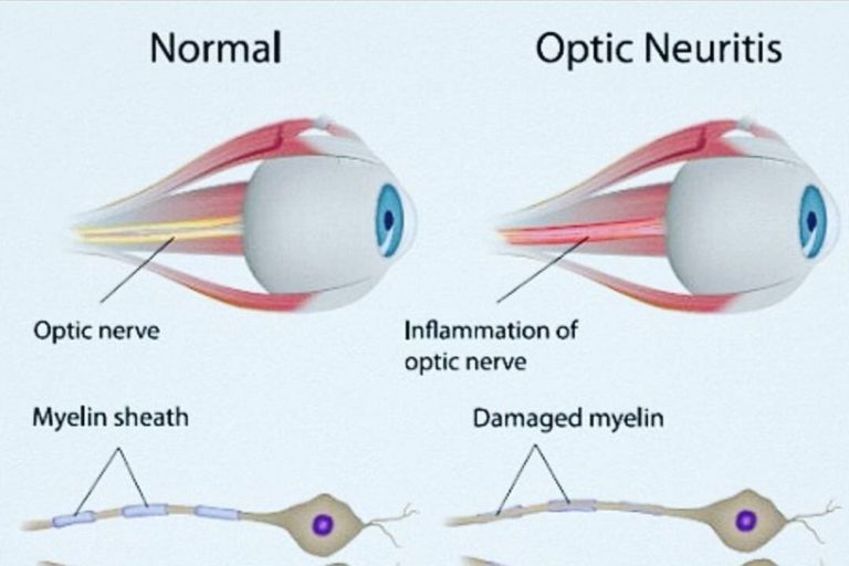 symptoms-causes-treatments-of-optic-neuritis-the-eye-news