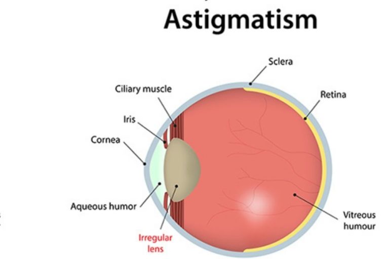 Why Are Lights Blurry if You Have Astigmatism? The Eye News
