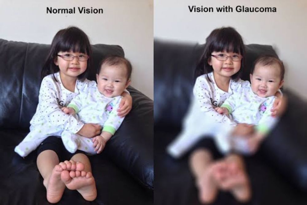 with and without glaucoma vision left versus right