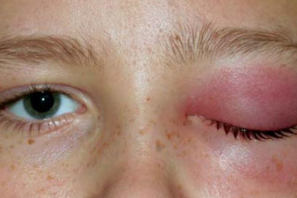 causes-of-red-rings-around-the-eyes-eye-conditions-the-eye-news