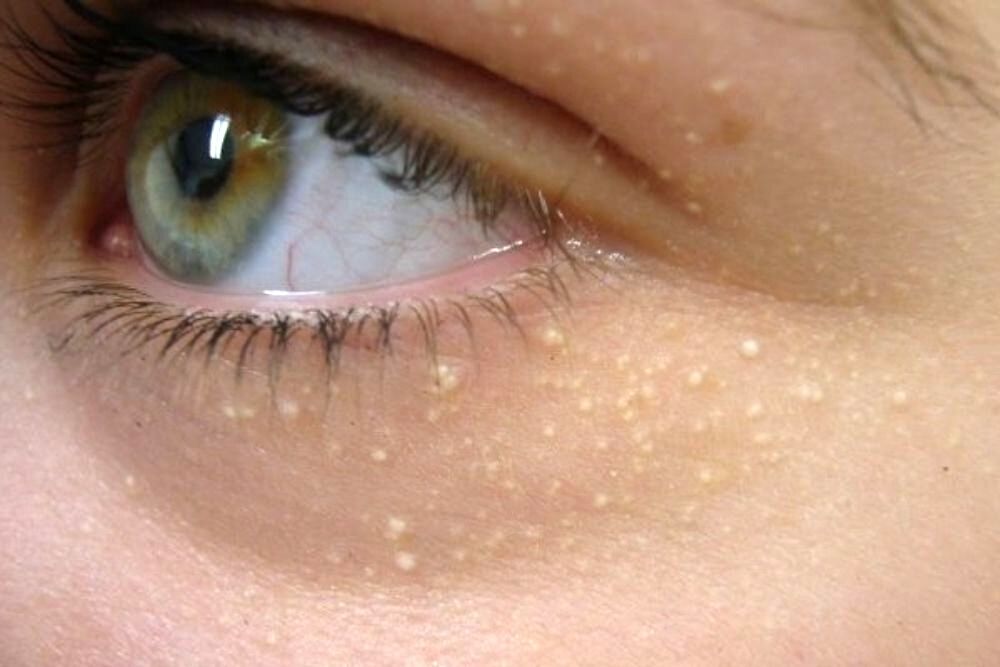 causes-of-white-bumps-under-the-eyes-eye-conditions-the-eye-news