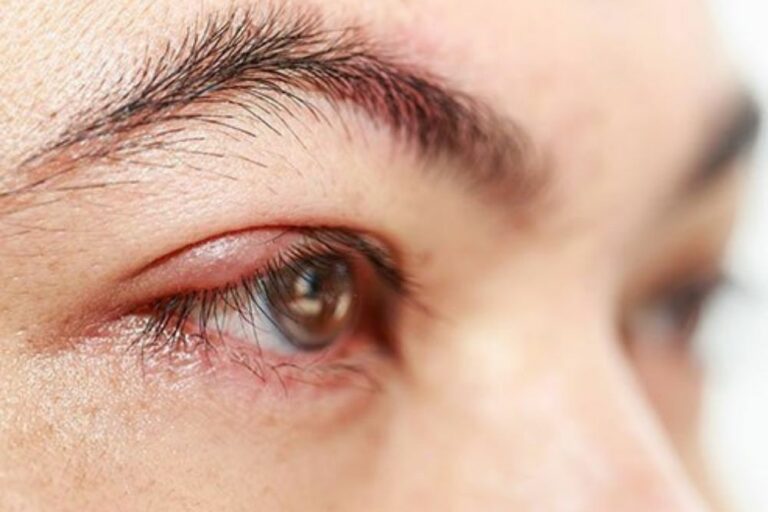 Causes Of White Bumps Under The Eyes Eye Conditions The Eye News   Causes Of White Bumps Under The Eyes 3 768x512 