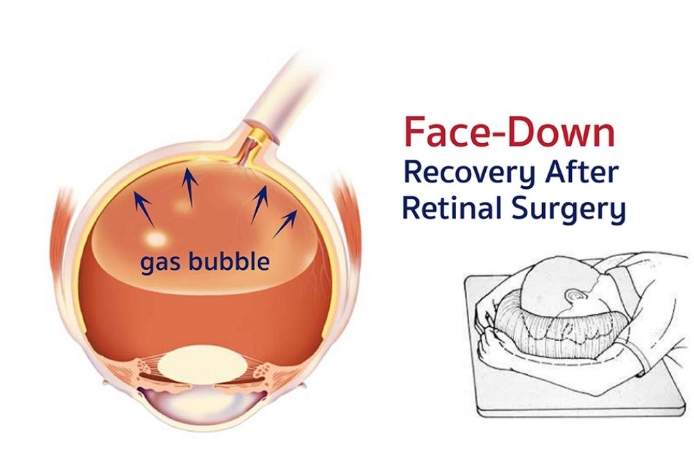 face-down recovery after retinal surgery