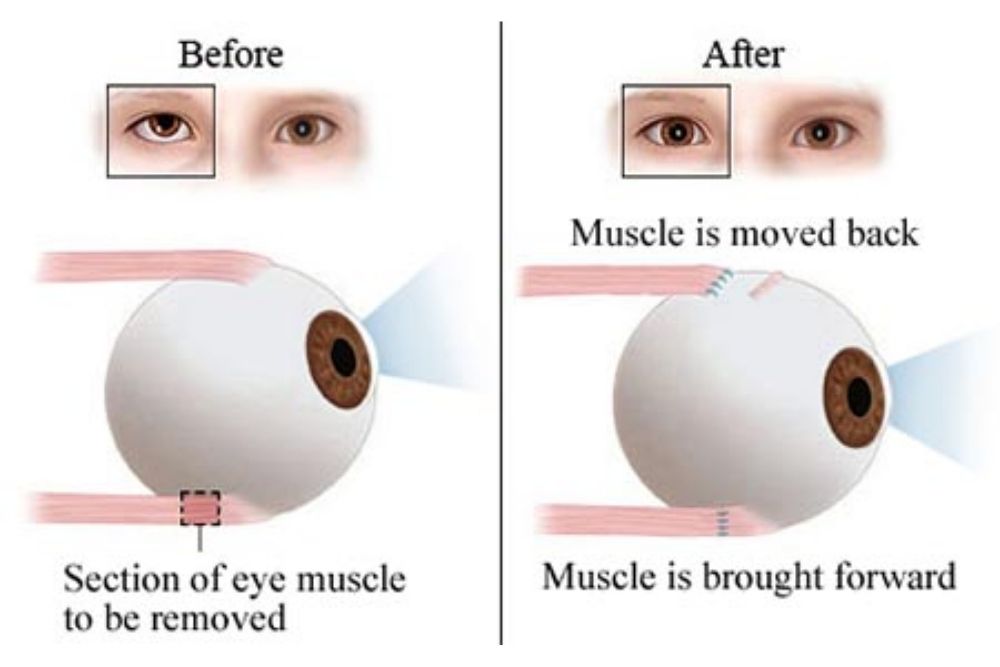 facts-about-lazy-eye-surgery-vision-surgery-the-eye-news