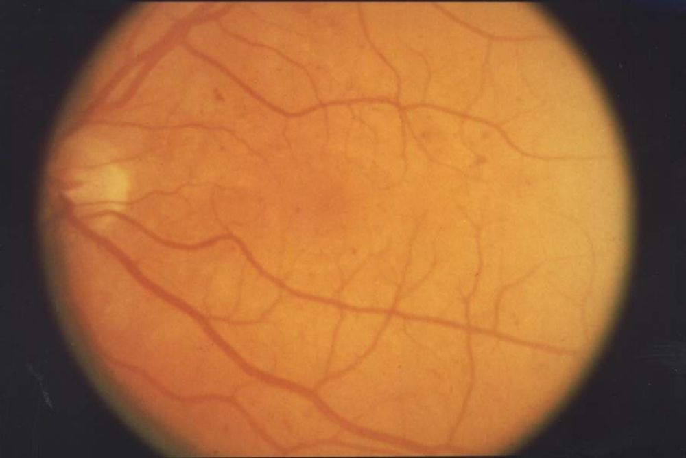 how can interferon affect the retina