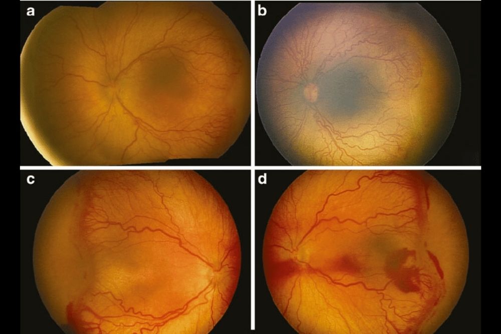 retinopathy of prematurity