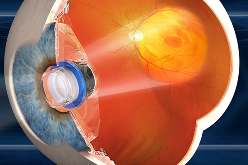 На сетчатку глаза за 3 с. Бионических имплантатов сетчатки (Argus, Argus 2),. Alpha IMS бионический глаз. Implantable Miniature Telescope. Эпиретинальные имплантаты сетчатки схема.